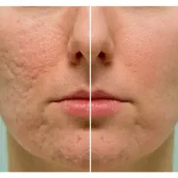 تخفیف ویژه بوتاکس، ژل، پی آر پی، رفع کک و مک|خدمات آرایشگری و زیبایی|بوکان, |دیوار