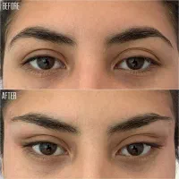 مدل لیفت صورت و ابرو با نخ توسط پزشک در کلینیک|خدمات آرایشگری و زیبایی|تهران, علم و صنعت|دیوار
