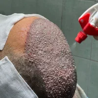 کاشت مو و ابرو فوق حرفه ای