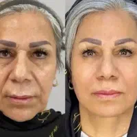 ژل و بوتاکس کاشت ابرو قسطی|خدمات آرایشگری و زیبایی|یاسوج, |دیوار