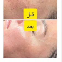 جشنواره تخفیف لیزر (ویژه بانوان)