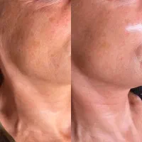 جوانسازی تخصصی پوست با PDRN اصل انگلیسی توسط پزشک|خدمات آرایشگری و زیبایی|تهران, ونک|دیوار