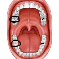 عصب کشی دندان خلفی با هزینه به صرفه
