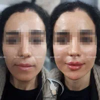 تزریق ژل (فیلر)و بوتاکس و لیفت بانخ ومادلینگ صورت|خدمات آرایشگری و زیبایی|تهران, هفت حوض|دیوار