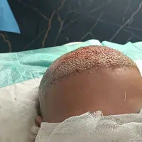 کاشت مو به روش میکروگرفت