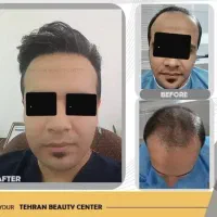 کاشت مو، کاشت ابرو، بلفارو، عمل بینی، رفع غبغب|خدمات آرایشگری و زیبایی|کرج, فاز ۱ مهرشهر|دیوار