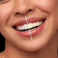 دندانهایی به سفیدی برف با سفید کننده دندان Vi-ONE|آرایشی، بهداشتی، درمانی|رشت, سعدی (تختی)|دیوار