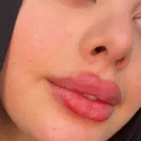 ژل فیلر بوتاکس آفر ویژه|خدمات آرایشگری و زیبایی|شیراز, سلطان آباد|دیوار