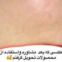 درمان لک درخانه|آرایشی، بهداشتی، درمانی|زرند, |دیوار