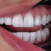 کامپوزیت فکی۸.۹۰۰، ایمپلنت با روکش ۱۹.۵، لمینیت ۱۳