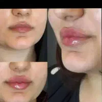 ژل بوتاکس چربی ساکشن ابدو
