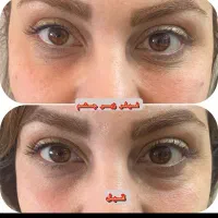 تزریق آموزش ژل بوتاکس چربی|خدمات آرایشگری و زیبایی|صدرا-فارس, فاز ۱|دیوار