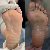 پدیکور خشک ودرمانی