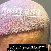 کاشت مو