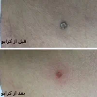 درمان زگیل پوستی/کرایو تراپی و لیزر/hpv|خدمات آرایشگری و زیبایی|اهواز, کیانپارس |دیوار