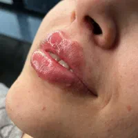 تزریق فیلر و کاشت ناخن|خدمات آرایشگری و زیبایی|خواف, |دیوار