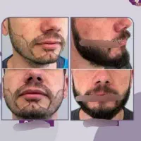 کاشت ریش/جذابیت مردونه ات روچندبرابرکن|خدمات زیبایی و سلامت|تبریز, |دیوار