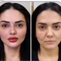 تزریق ژل بوتاکس و نخ توسط پزشک در کلینیک