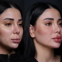 تزریق چربی به باسن هیپ دیپ صورت بیکینی وصورت