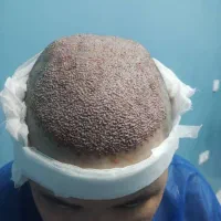 کاشت مو و ابرو vip تخصصی با ضماتنامه معتبر و کتبی