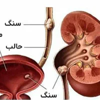 درمان گیاهی کلیه سنگ ساز