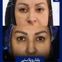 آموزش جراحی صورت کاشت ابرو بلفاروپلاسی ساکشن غبغب|خدمات آموزشی|اصفهان, خواجو|دیوار