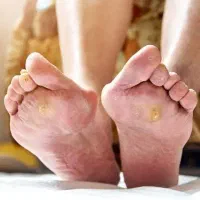 درمان زخم بستر، زخم دیابتی، سوختگی در دو جلسه