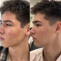 جوش  و جای جوش ولک وجای لک