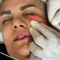 اندولیفت/ جوانسازی /تخلیه چربی صورت / رفع سلولیت|خدمات آرایشگری و زیبایی|تهران, صادقیه|دیوار