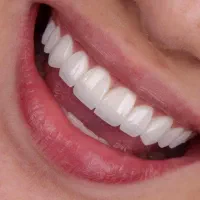 جشنواره ی تخفیف ایمپلنت و کامپوزیت به مدت ۵ روز