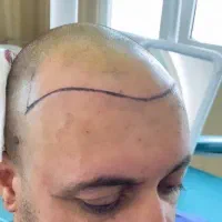 کاشت مو ۴ قسطه بدون نیاز به چک وضامن