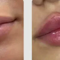 پاکسازی بادستگاه.بوتاکس.فیلر.برداشتن خال