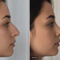 لیفت بینی روش جدید ان ال بینی