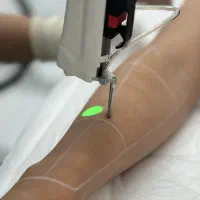 استخدام اپراتور لیزر