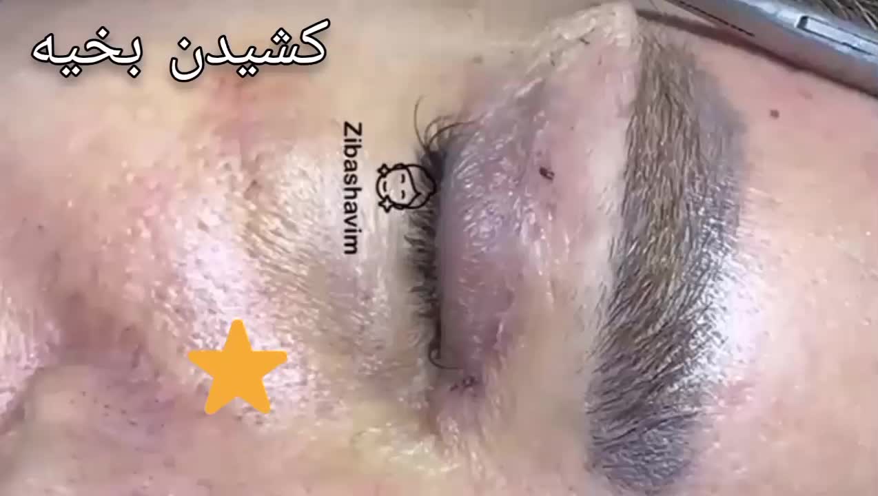 لیفت شقیقه بلفاروپلاستی|خدمات آرایشگری و زیبایی|تهران, میرداماد|دیوار