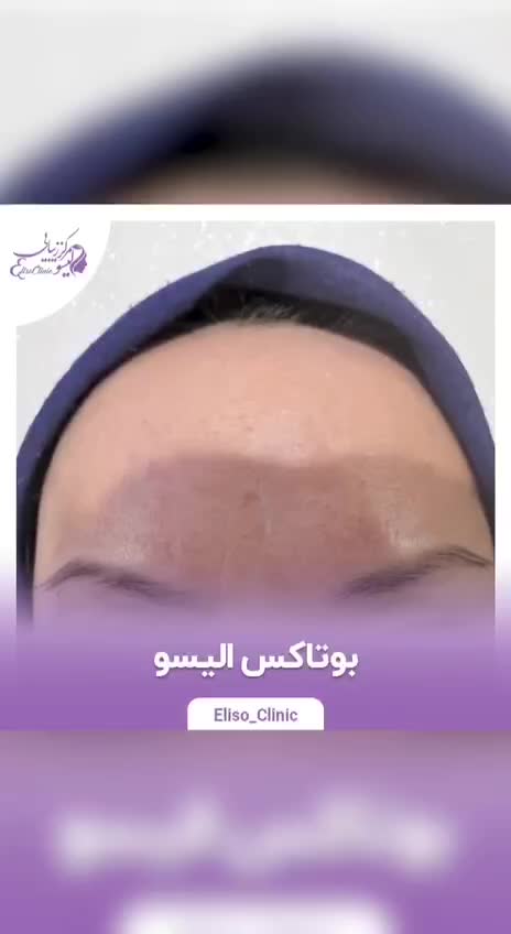 کلینیک تزریق ژل بوتاکس لیزر هایفو فشیال خال فیلرلب|خدمات آرایشگری و زیبایی|تهران, پیروزی|دیوار