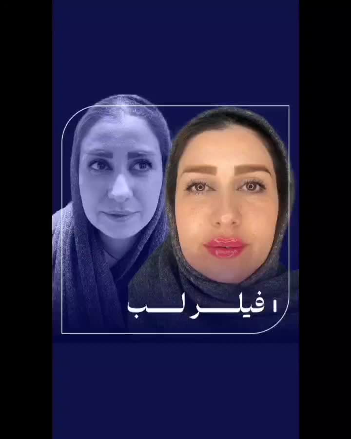 لیفت بایوفیس صورت مزو ژل بوتاکس اصلاح بینی نخ|خدمات آرایشگری و زیبایی|مشهد, احمدآباد|دیوار