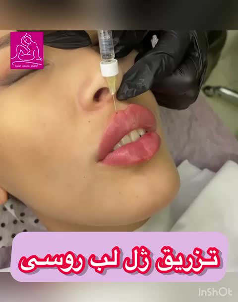 ژل لب مدل روسی و طبیعی بوتاکس میگرن مزوژل|خدمات آرایشگری و زیبایی|تهران, شاهین|دیوار
