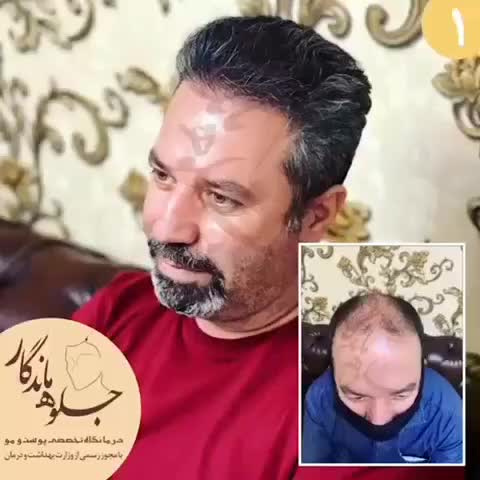 کاشت مو با جدیدترین متد روز دنیا|خدمات آرایشگری و زیبایی|تهران, عباس‌آباد|دیوار