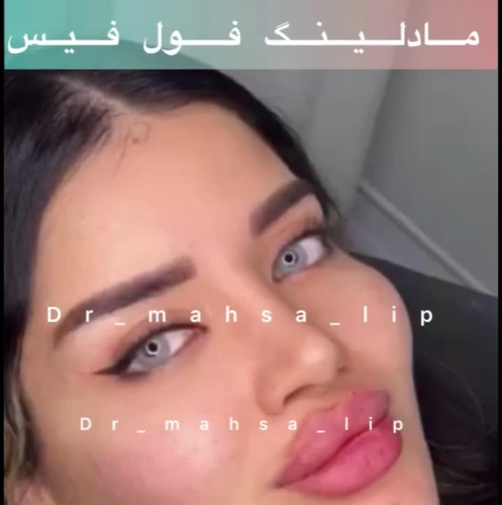 پزشک زیبایی تزریق ژل گونه فیلرچانه لب روسی مادلینگ|خدمات آرایشگری و زیبایی|تهران, پونک|دیوار
