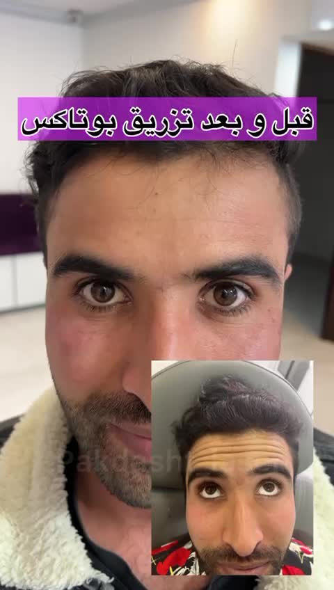 تزریق بوتاکس مصپورت ، کامل صورت توسط پزشک|خدمات آرایشگری و زیبایی|پاکدشت, پاکدشت (مامازند)|دیوار