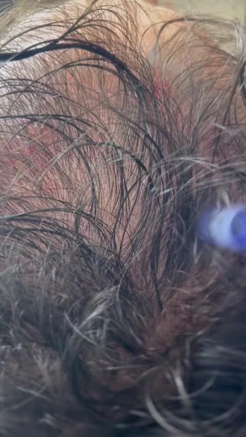 مزوتراپی و مزونیدلینگ مو درمان ریزش مو و رویش مجدد|خدمات آرایشگری و زیبایی|قائم‌شهر, |دیوار