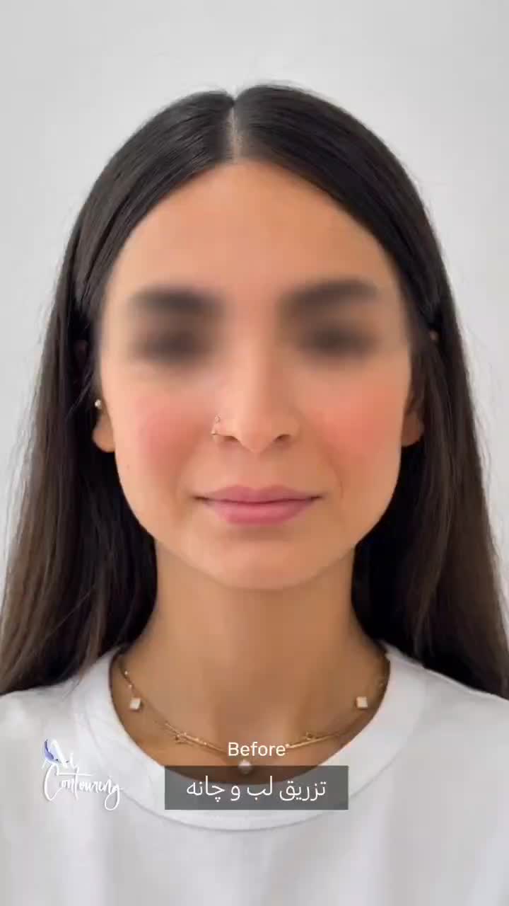 نخ کل صورت 55000فیلر 690بوتاکس 690|خدمات زیبایی و سلامت|تهران, جیحون|دیوار