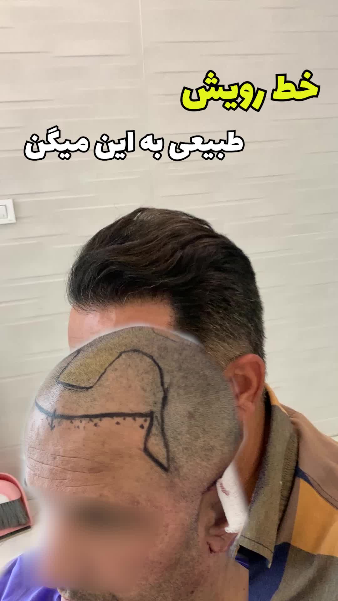 کاشت مو و ریش با ضمانت|خدمات آرایشگری و زیبایی|شیراز, قصرالدشت|دیوار