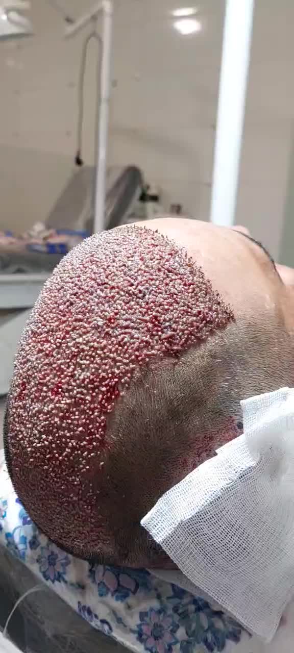 کاشت مو و ابرو قسطی در شیراز|خدمات آرایشگری و زیبایی|شیراز, قصرالدشت|دیوار