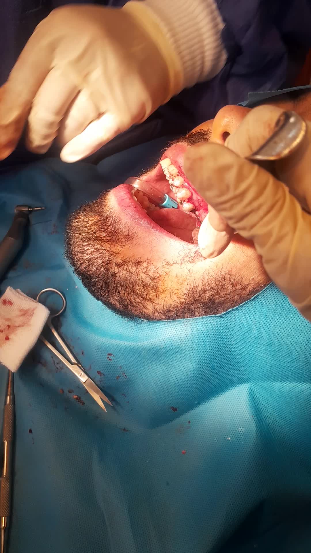 جراحی ایمپلنت و روکش ( فیکسچر کره ای)|خدمات آرایشگری و زیبایی|رشت, گلسار|دیوار