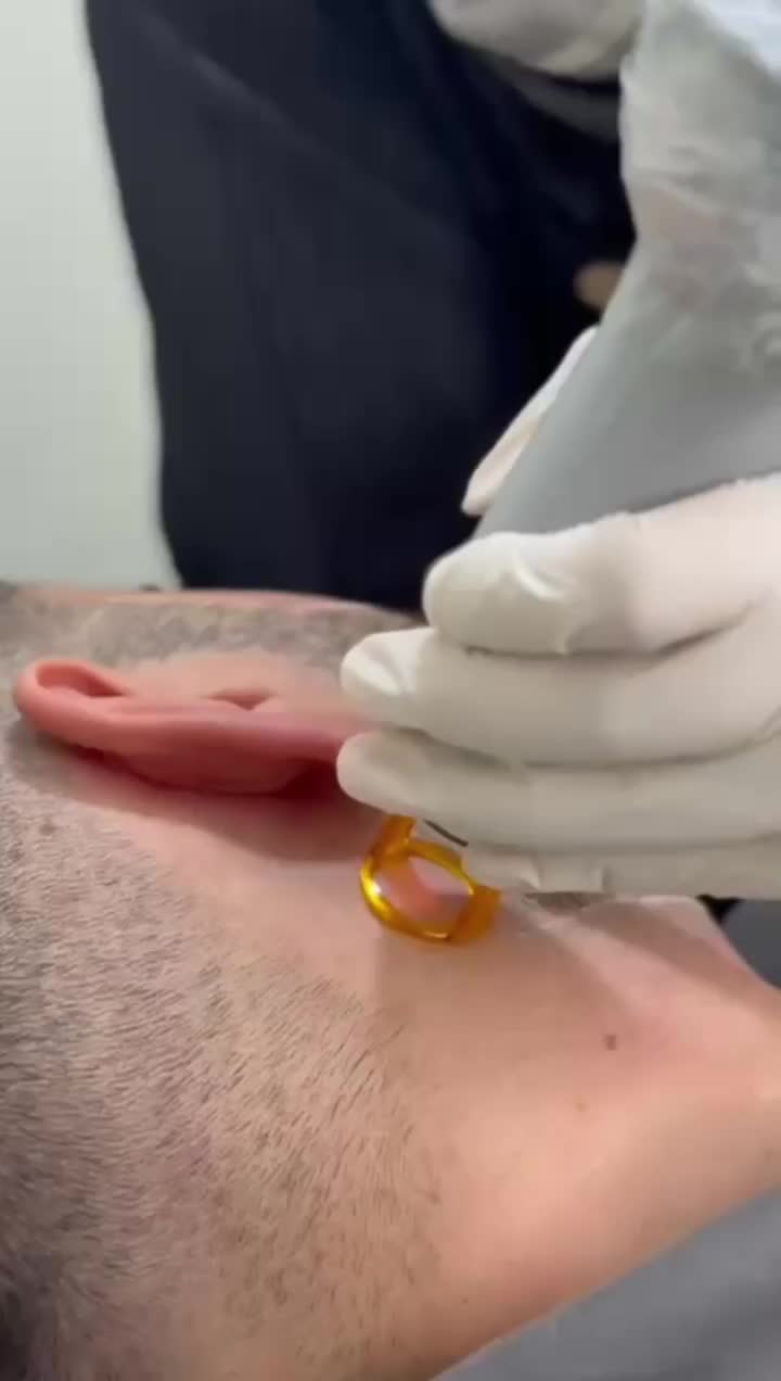 لیزر مو های زائد الکساندر کندلا|خدمات آرایشگری و زیبایی|یاسوج, |دیوار