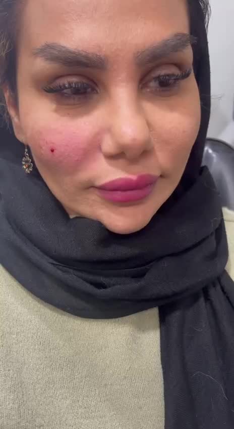 خدمات ژل و بوتاکس|خدمات آرایشگری و زیبایی|ساری, |دیوار