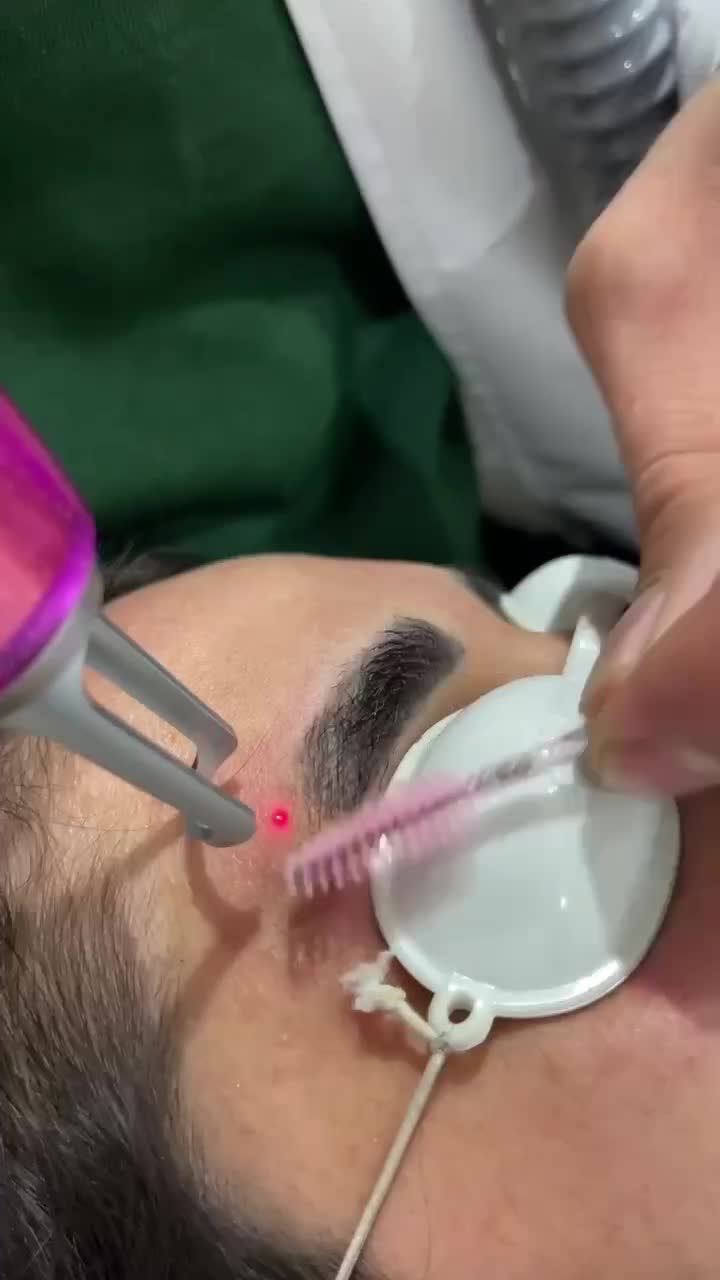 پاک کردن تتو با لیزر/ریموو ابرو/کربن تراپی(پزشک)|خدمات آرایشگری و زیبایی|مشهد, فردوسی|دیوار