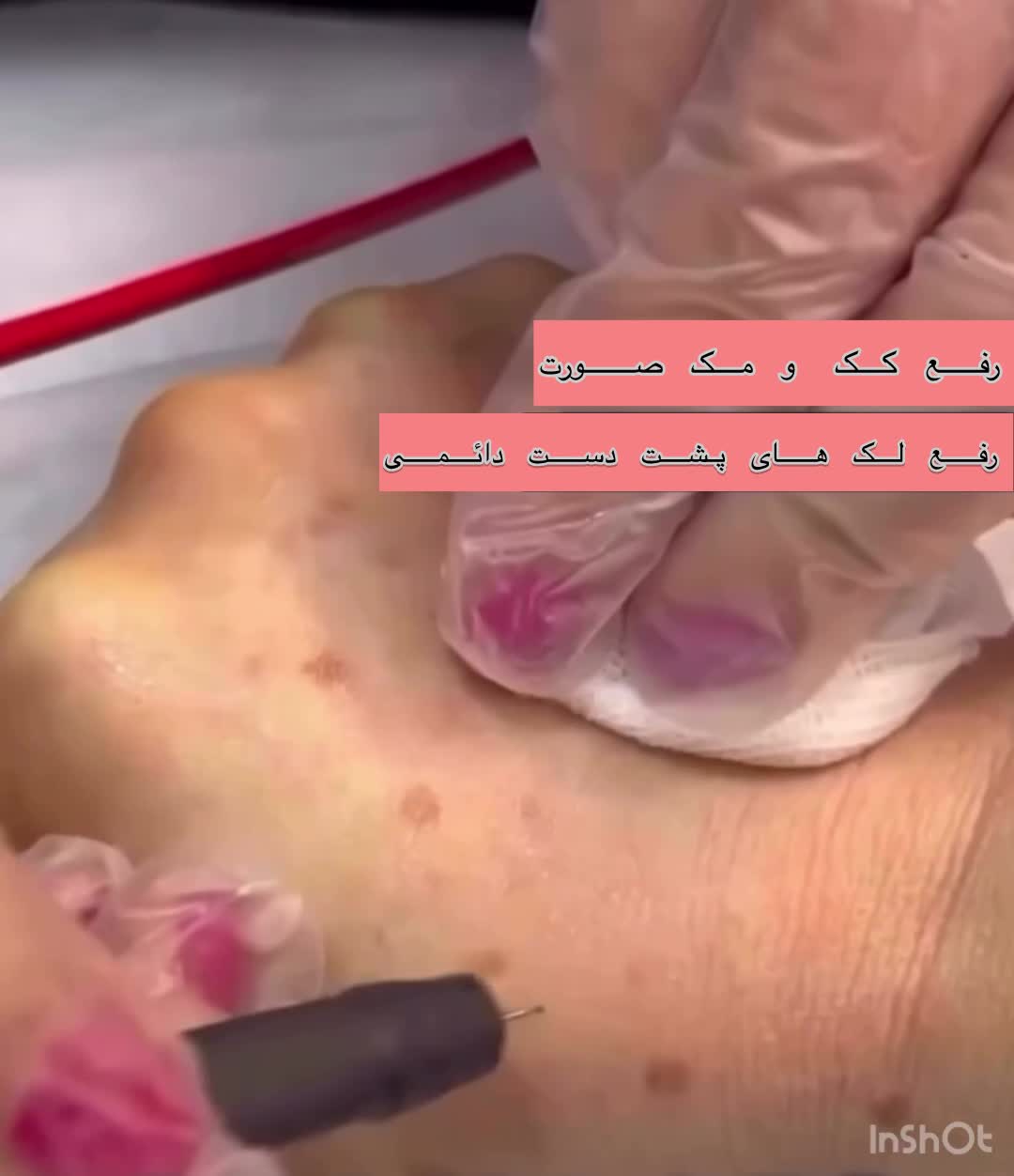 لیزر ، الکترولیز ، روشن سازی ، کک‌ و مک توسط پزشک|خدمات آرایشگری و زیبایی|بندرعباس, |دیوار